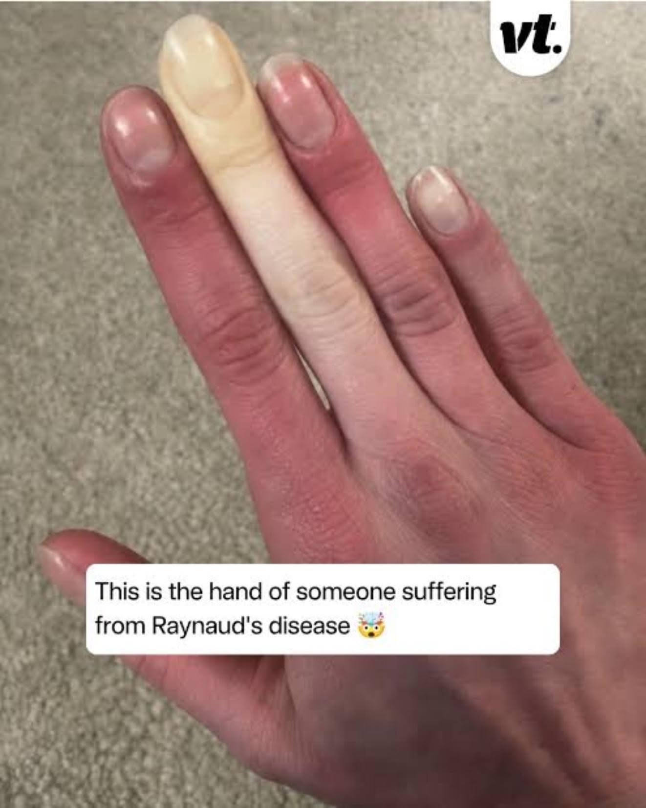 If Your Fingers Suddenly Turn White, You May Have This Little-Known Condition
