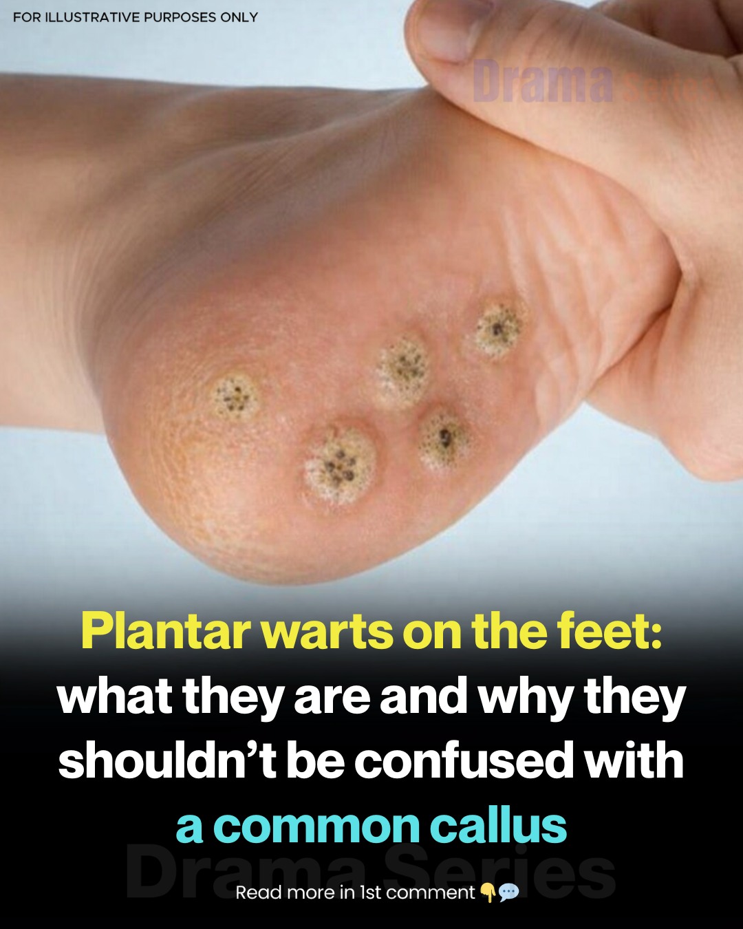 Understanding the Difference Between Calluses and Plantar Warts - latellagelato.com