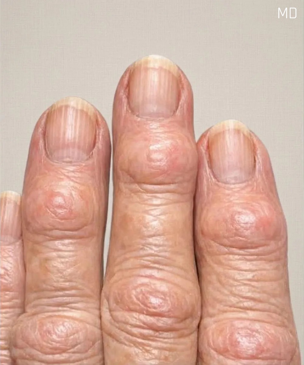 My grandma has these hard bumps forming on her finger joints near the nails. Why is this spreading?