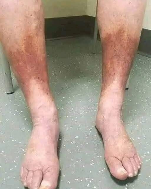 Swollen Feet: Common Causes, Warning Signs, and When to Seek Medical Advice - Daily Stories