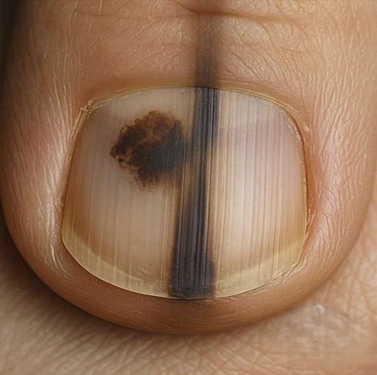 This is not a bruise: it is one of the most aggressive skin tumors, and many people mistakenly consider it a simple bump.