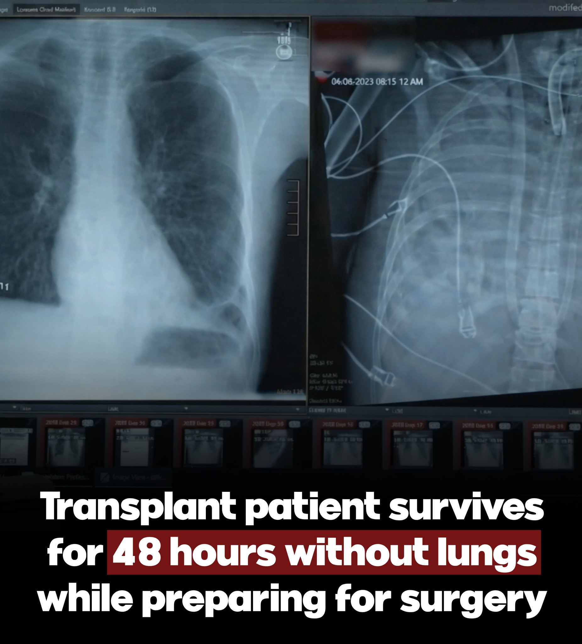 48 Hours Without Lungs: The Extraordinary Case That Showed the Power of Modern Medicine