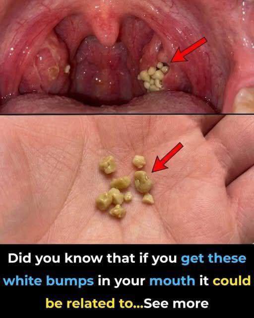 Here’s what you need to knows about tonsil stones – the weird pimple-like growths in your throat