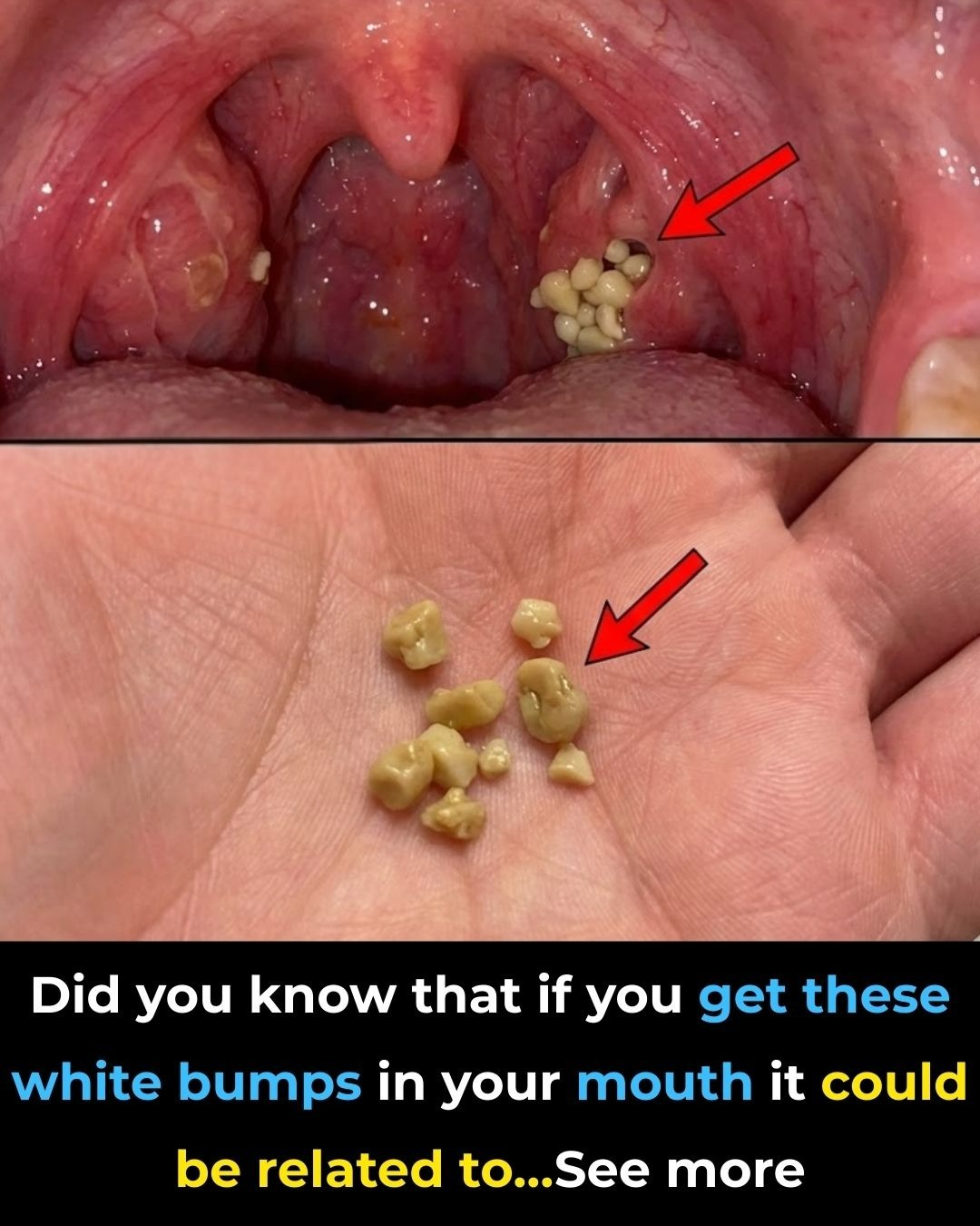 Tonsil Stones: What They Are, Why They Appear, and How to Manage Them for Good