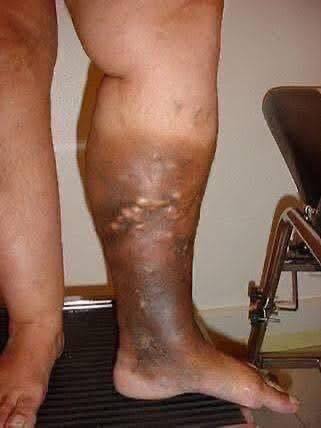 These are the first symptoms that are cre… See more
