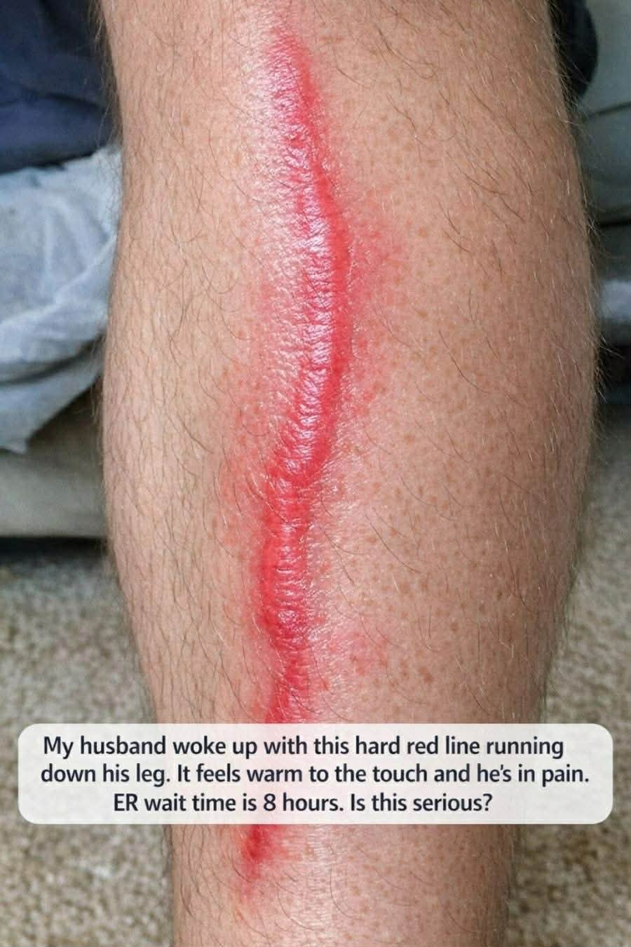 My Husband Woke Up With This Hard Red Line Running Down His Leg. It's Warm and Painful. Is This Serious?