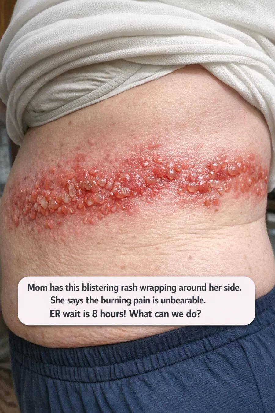 Mom has this blistering rash wrapping around her side. She says the burning pain is unbearable. ER wait is 8 hours! What can we do?