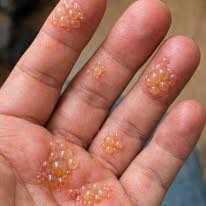 Husband’s fingers are covered in these tiny water blisters. He can’t even type for work. We need help asap!