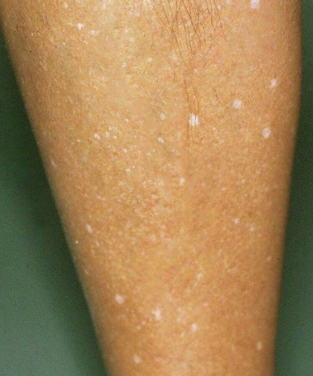 Unexplained White Marks on Your Skin? These Vitamins May Be Missing