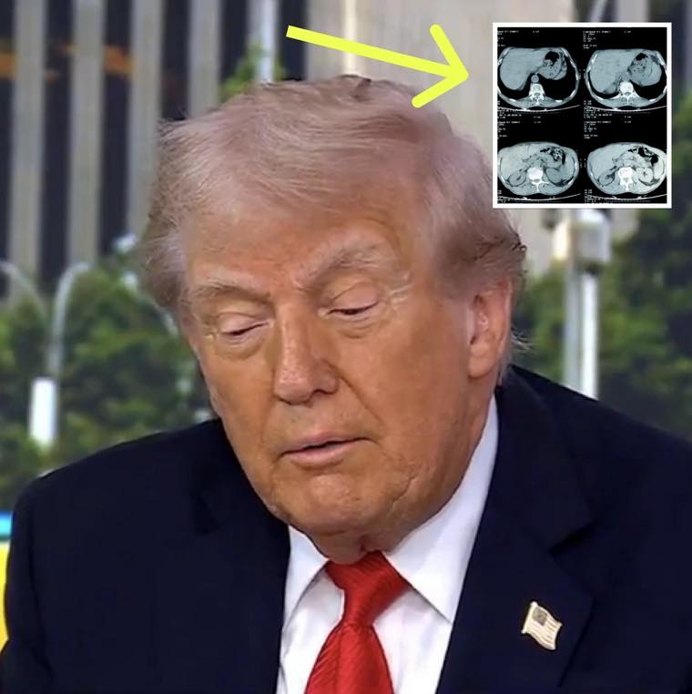 Internet On Edge After Trump Reveals The Results Of His MRI Scan