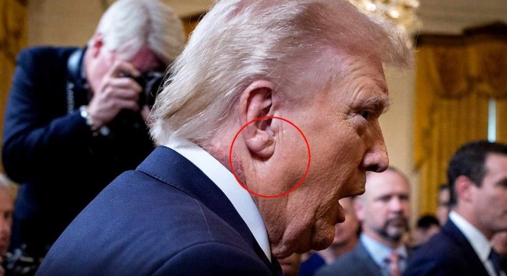 ‘Frank’s Sign’ on Trump’s ear could be huge indicator of potentially fatal health condition