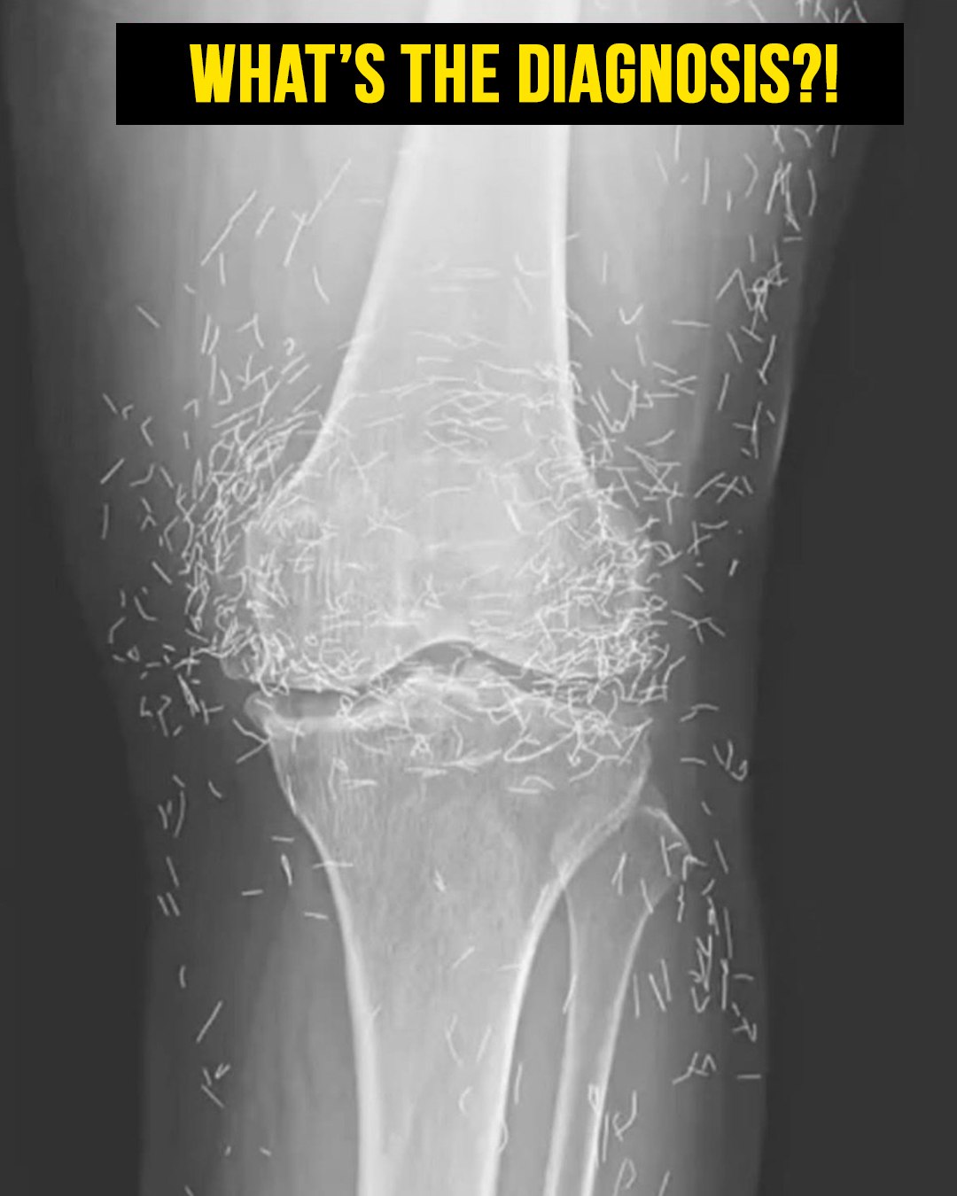 Doctors find “gold mine” in woman’s knees