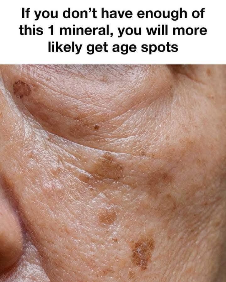 Age Spots: Causes, Prevention, and Effective Treatments