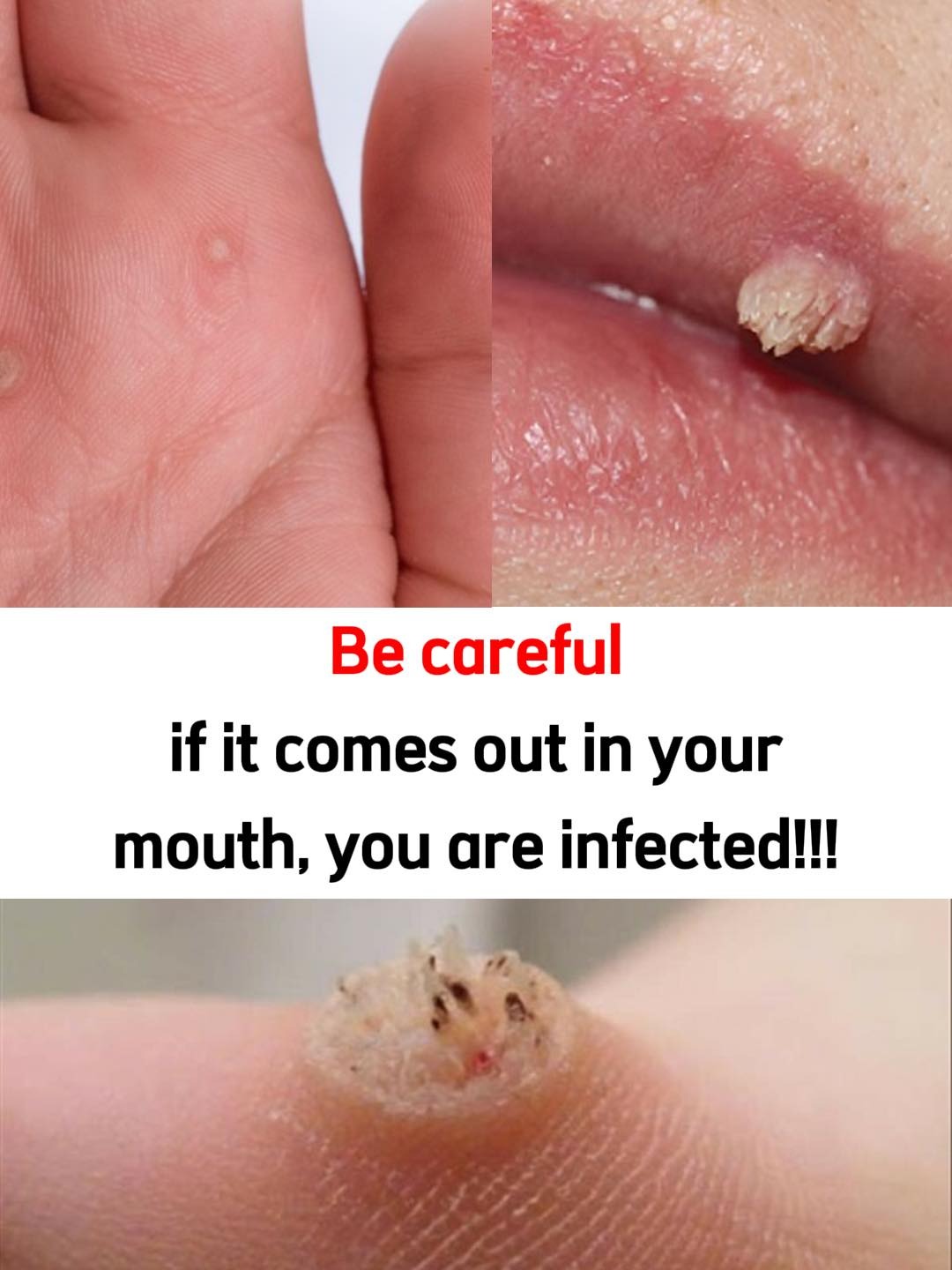 You Have Been Ignoring These Wart Removal Tricks for Years, Doctors Say Some Actually Work But There Is a Catch
