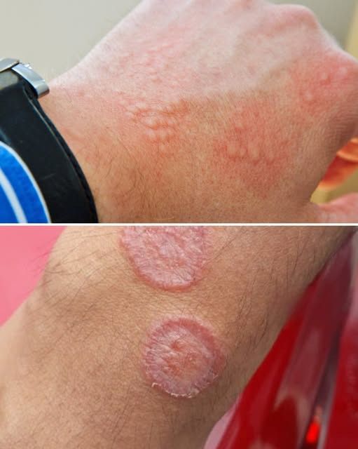 Warning Signs of Severe Allergic Reaction: When a Skin Rash Becomes a Medical Emergency
