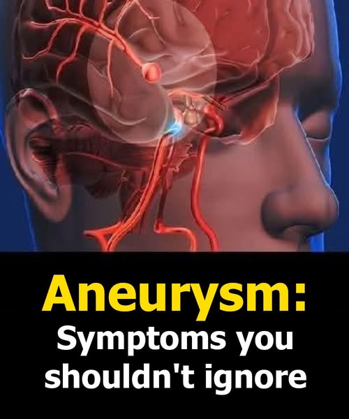 Aneurysm: Signs You Shouldn’t Ignore
