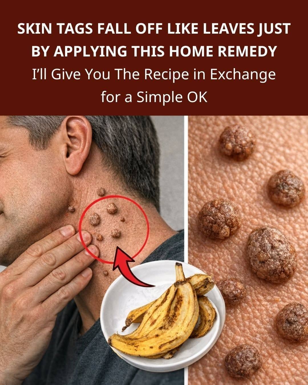 The warts will fall off like leaves simply by applying this home treatment. I’ll give you the recipe in exchange for just one word, 1