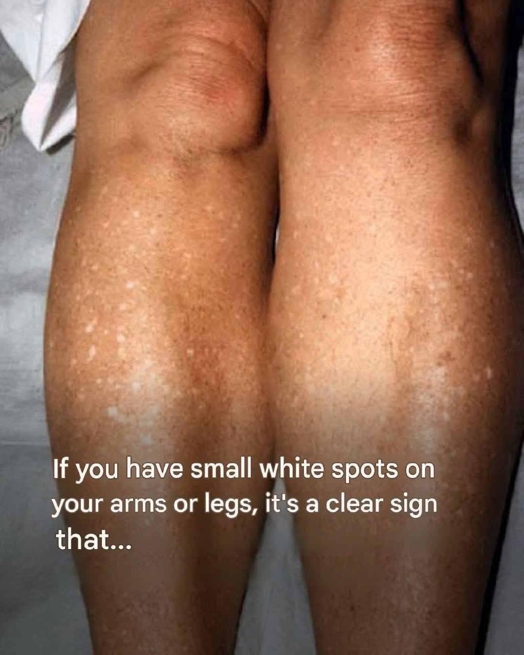 Why do I get white spots on my skin in the summer and how can I treat them? A dermatologist answers