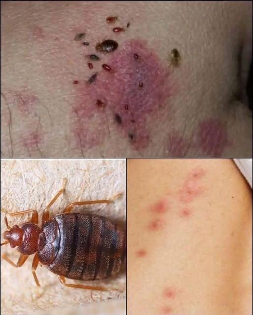 Understanding Scabies: Symptoms, Risks, and What to Look Out For -
