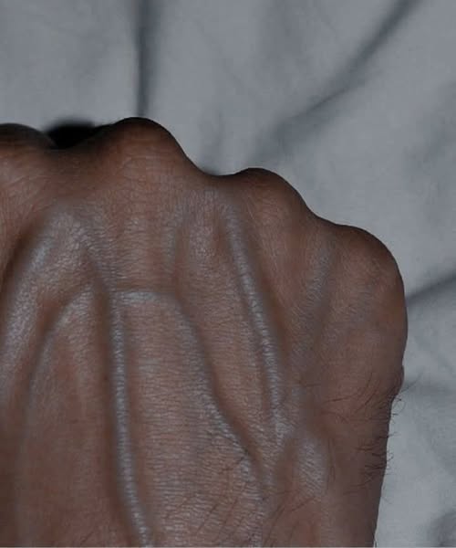 Why Veins Become More Visible with Age