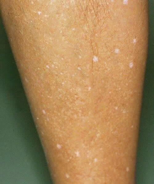 What Vitamin Deficiencies May Lead to White Spots on the Skin
