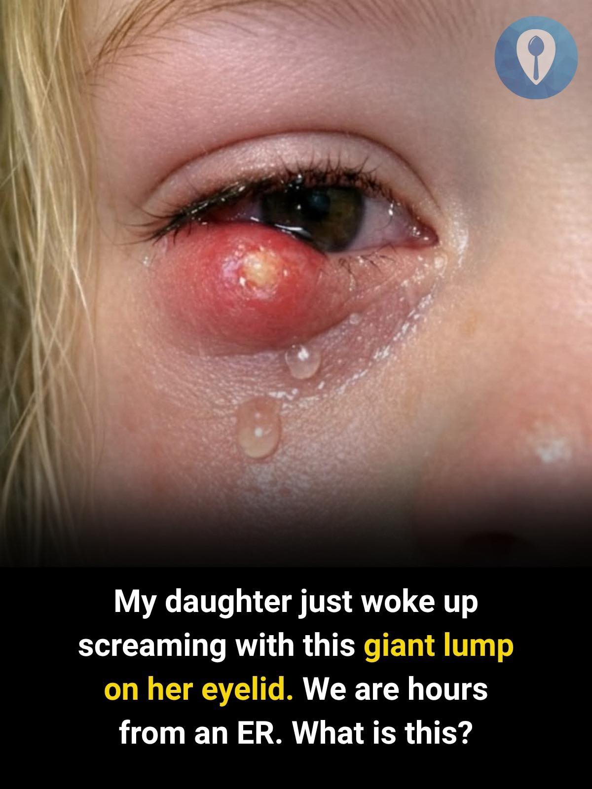 A Sudden Lump on Your Child’s Eyelid? What Parents Should Know - Recipes