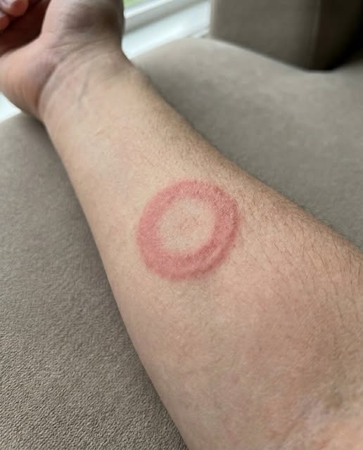 5 Simple Home Remedies to Prevent Ringworm and Keep Your Skin Healthy