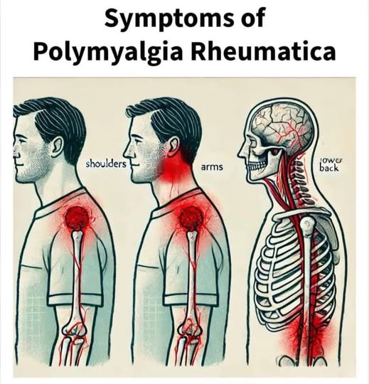 Polymyalgia Rheumatica: Key Symptoms and Indicators​