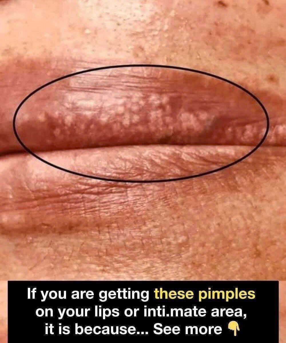Understanding White Pimples on Your Lips: Key Signs, Causes, and When It’s Important to Consult a Dermatologist to Ensure Proper Diagnosis and Treatment, Avoid Complications, and Maintain Healthy Skin, While Distinguishing Between Harmless Conditions and Potentially Serious Issues That Require Professional Medical Attention Without Delay