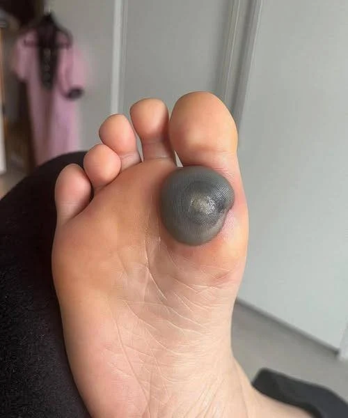 My Daughter Woke Up With This Huge Spot on Her Foot – What Could It Be?