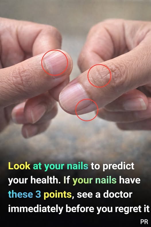 Having Striped Nails Could Mean That Your Body Is… More Details below