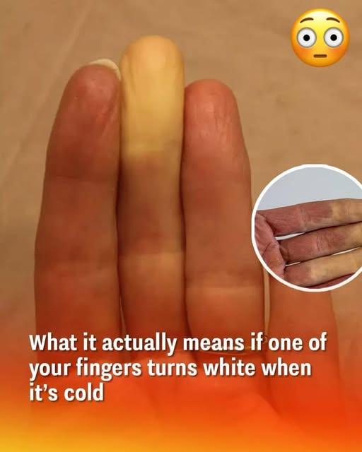 Raynaud’s Phenomenon: Why Fingers Turn White in the Cold