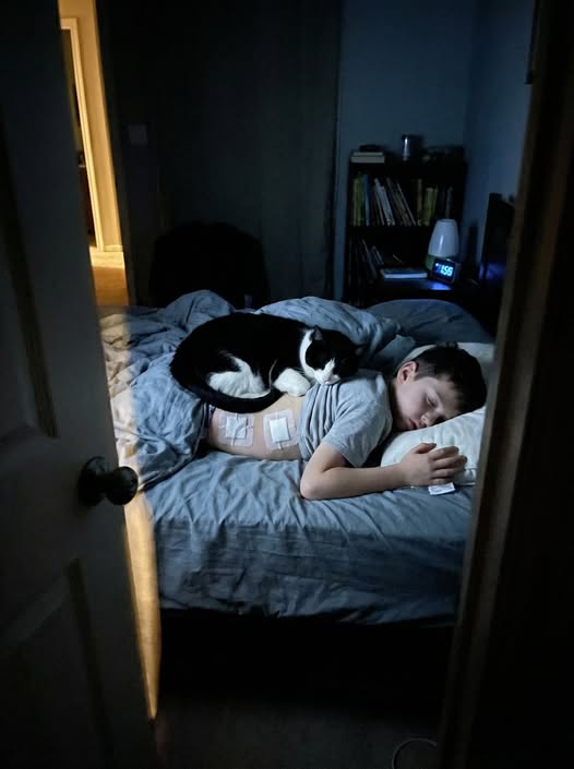 A Boy Donated His Bone Marrow To Save His Sister. The Pain Was So Bad He Couldn't Sleep For 11 Days. Every Night, Their Cat Lay On His Back Covering The Wound. He Never Told Anyone The Cat Was The Only Thing That Helped.