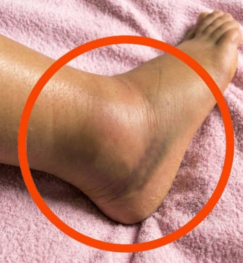 If You Notice Your Legs Are Swollen, Doctors Warn It Could Be a Sign of a Serious Underlying Condition That Many People Overlook Until It Becomes Dangerous. What Seems Like a Simple Change in Your Body May Actually Be Linked to Circulation Problems, Fluid Retention, or Other Health Issues That Should Never Be Ignored Without Proper Medical Attention Immediately