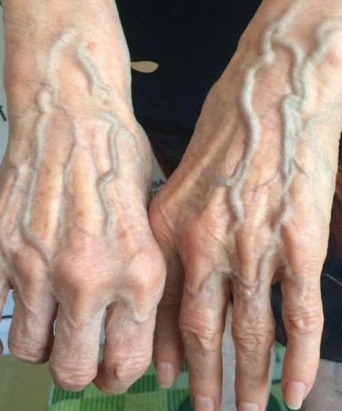 If You Can See Veins on Your Hands, Here’s What It Actually Means