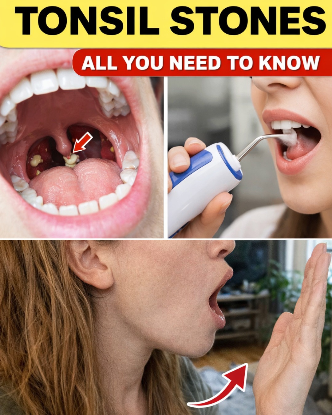 What Are Tonsil Stones and How Can Simple Daily Habits Help You Manage These Hidden Throat Troubles?