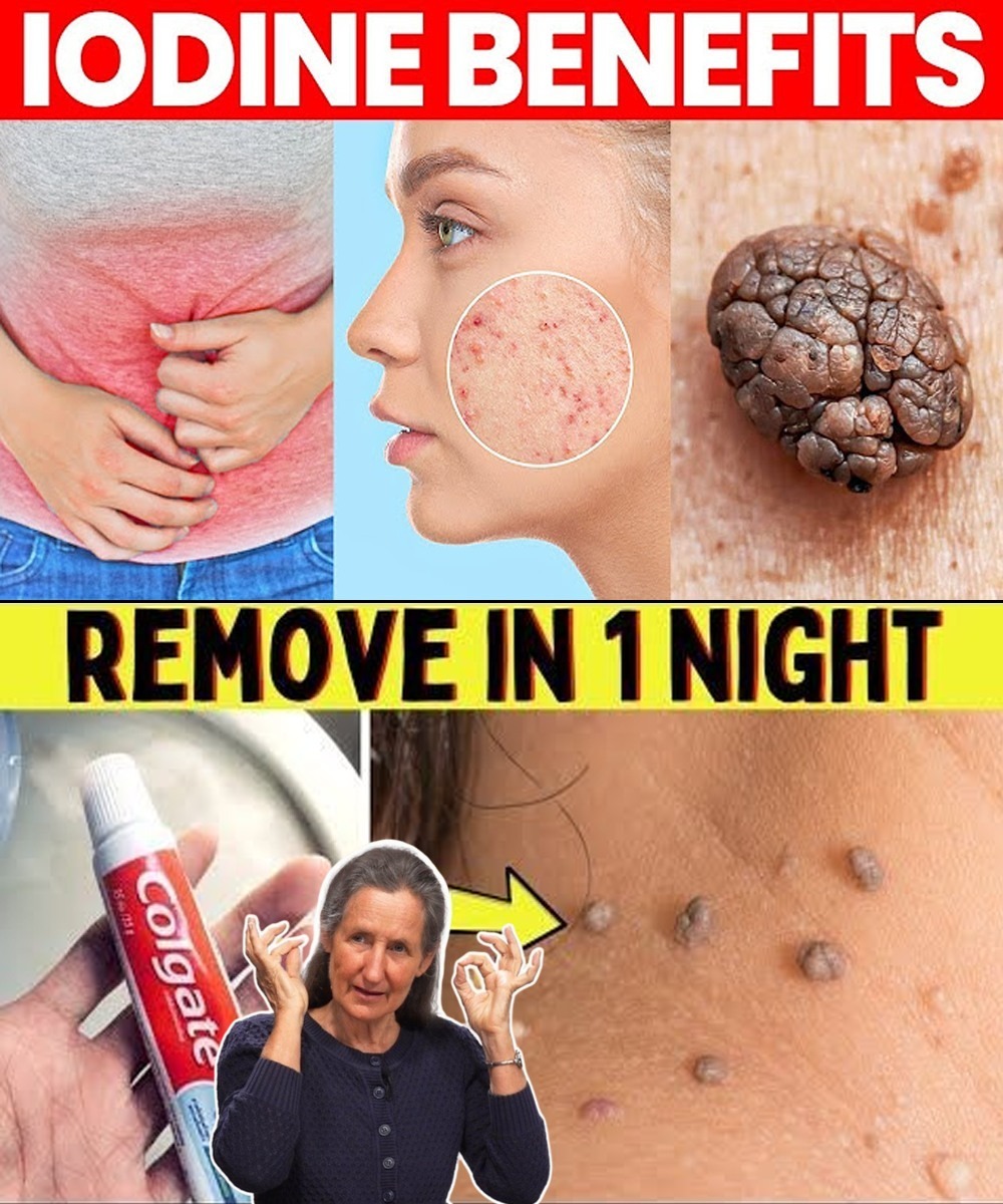 Remove Warts & Skin Tags Naturally With This Simple 3-Ingredient Blend