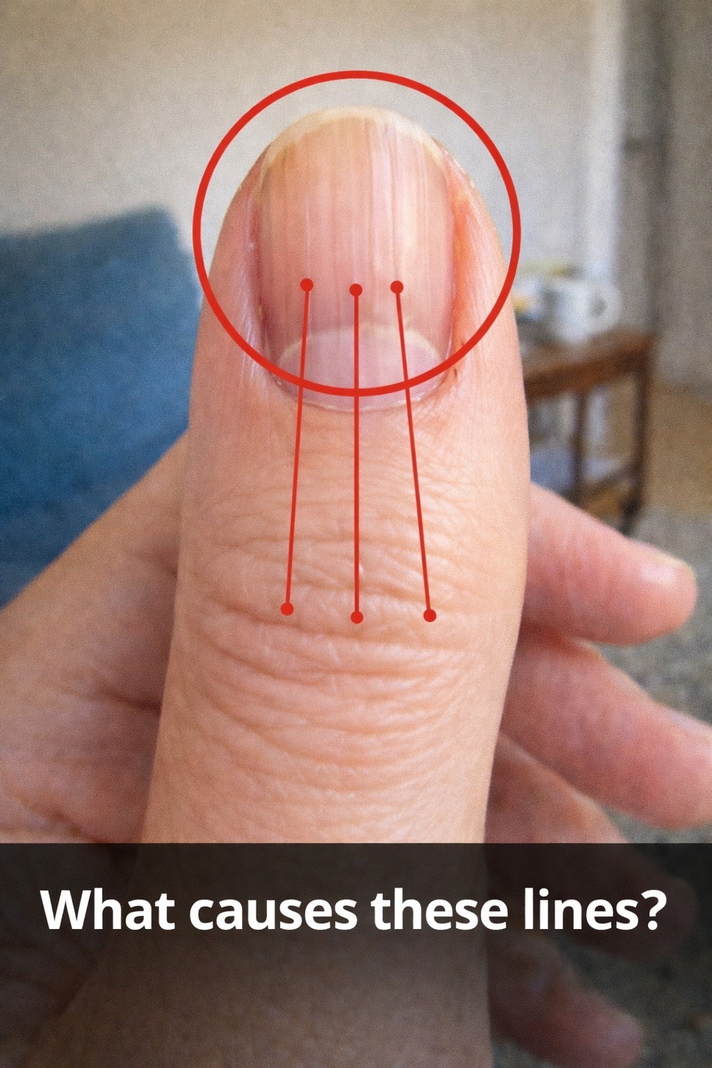 Lines on Your Nails? A Quiet Warning You Shouldn’t Ignore