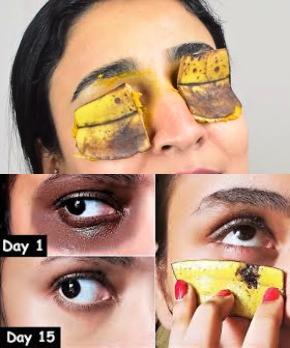 Banana Peel for Dark Circles: I Tried It—and Here's What Happened
