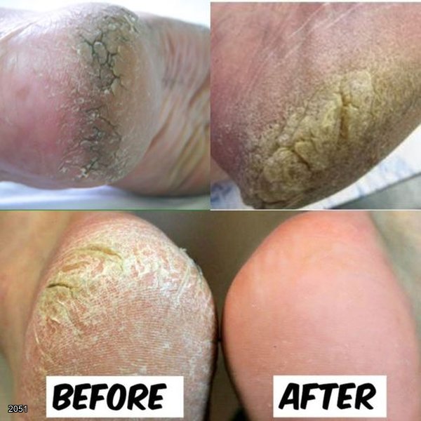 Home Remedy to Remove Cracked Heels Fast “OVERNIGHT” – Great Results