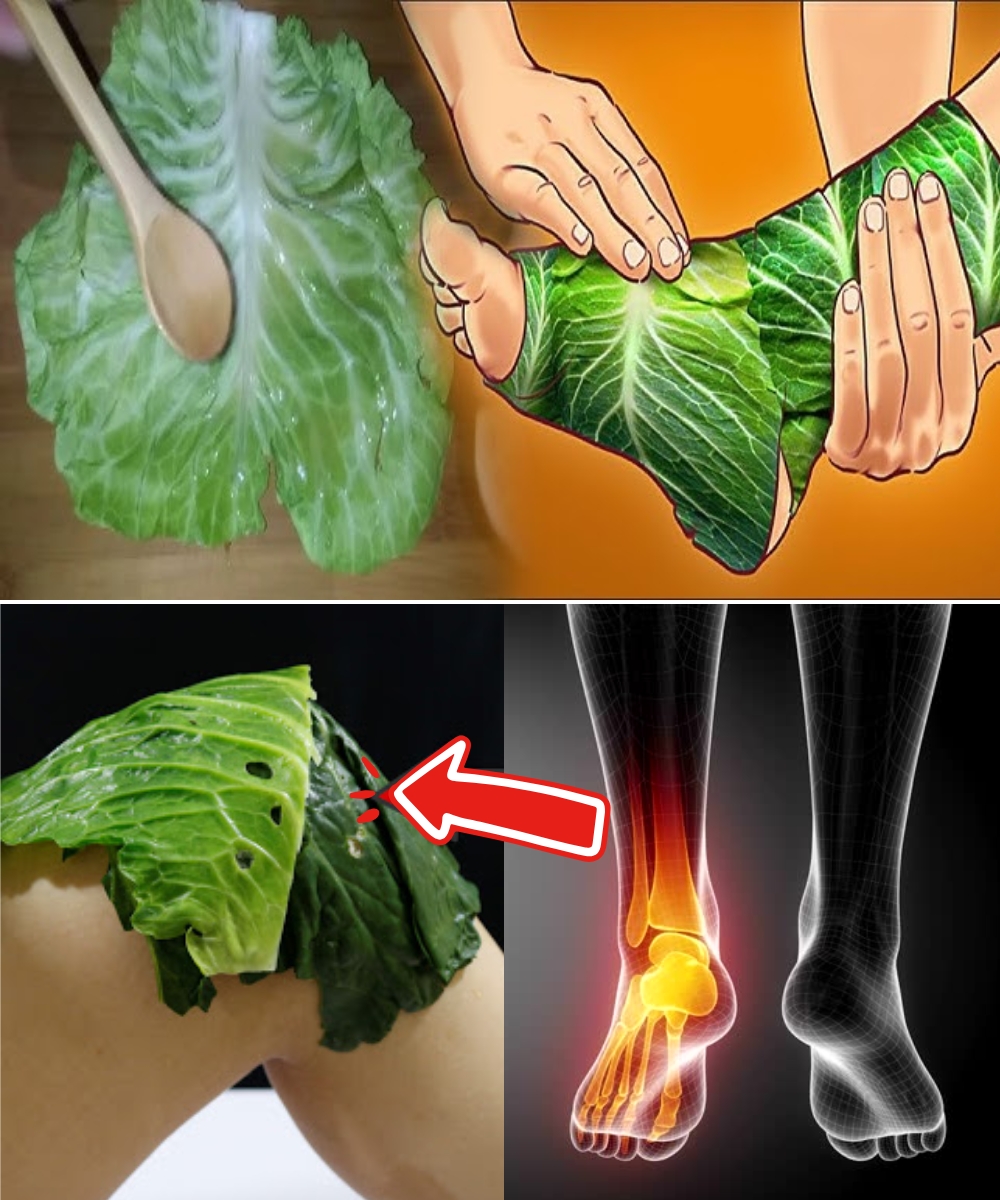 Natural Relief for Varicose Veins with Cabbage Leaves