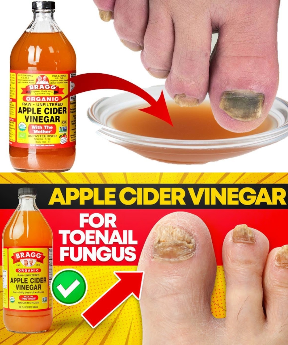 Toenail Fungus Treatment Using Apple Cider Vinegar: A Fast and Cheap Cure