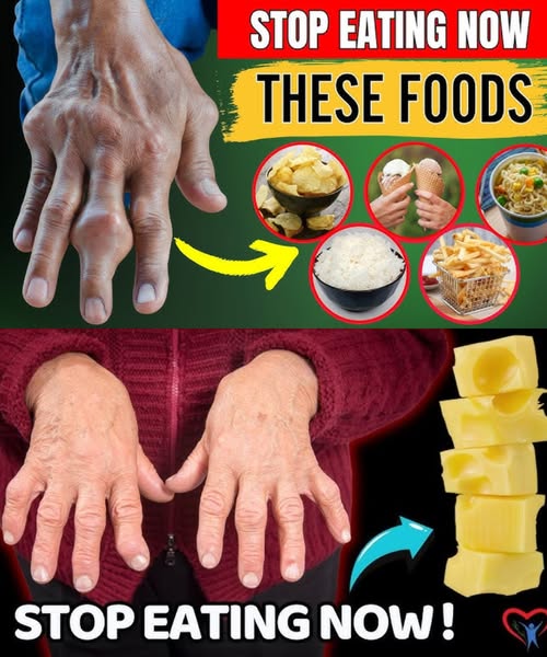 7 Foods That May Worsen Arthritis – And What to Eat Instead
