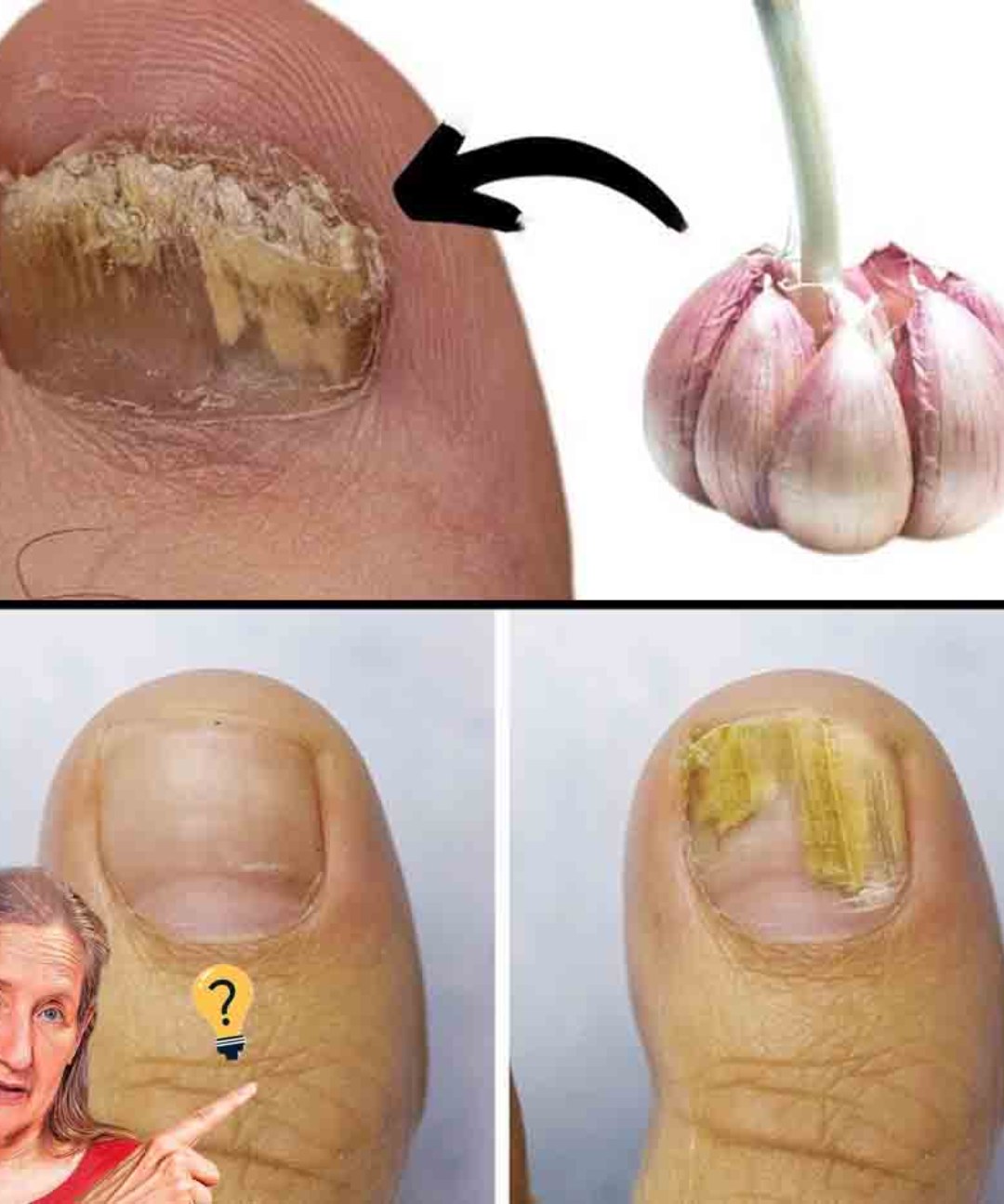 Say Goodbye to Foot Fungus: How Garlic Can Naturally Heal Your Feet