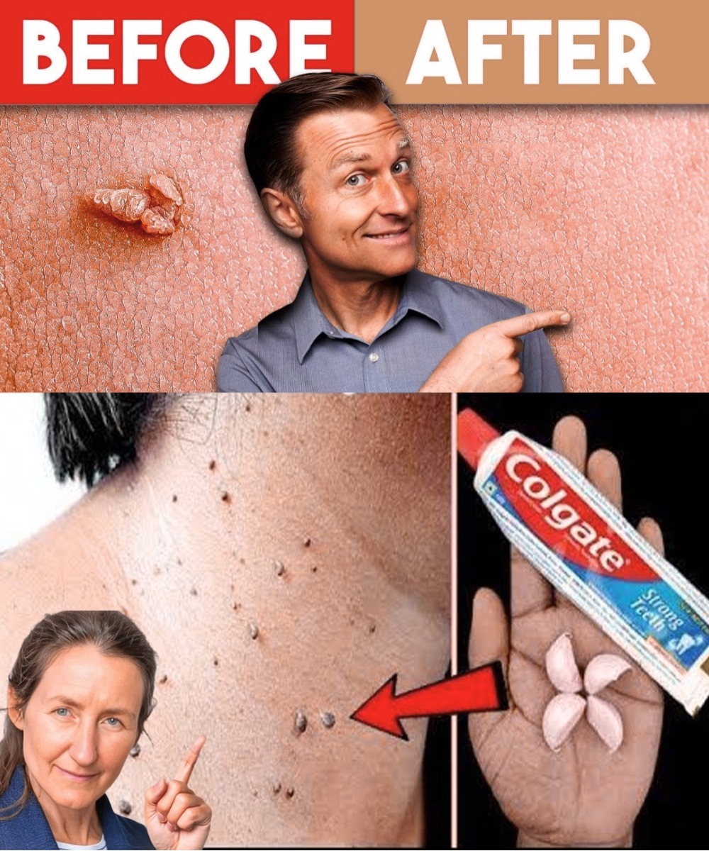 Natural Overnight Remedy for Skin Tags and Warts – Gentle, Simple, and Effective