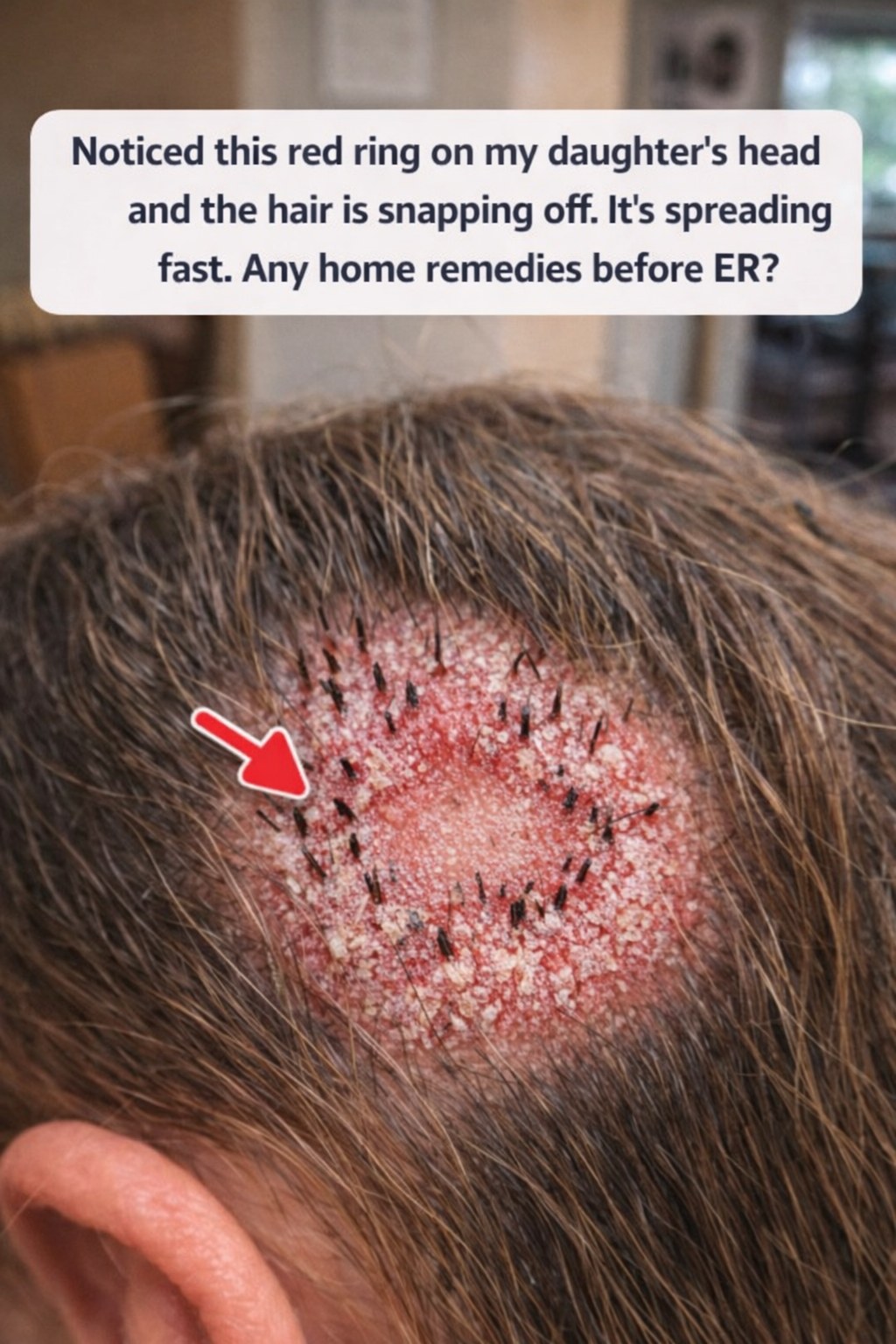 Red Rings on Your Child’s Scalp with Hair Breaking Off? Essential Guidance for Parents