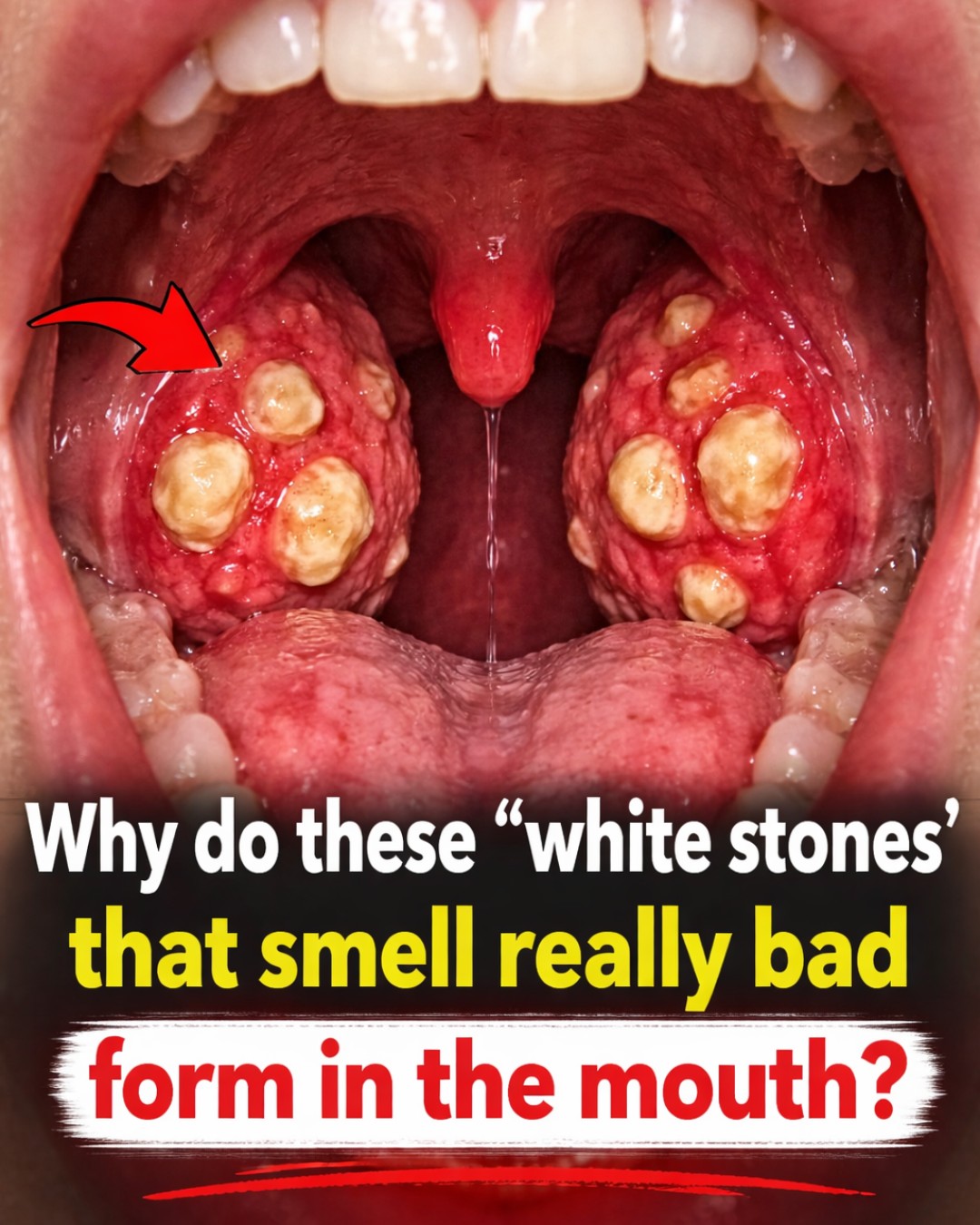 Why Do These White Stones That Smell Really Bad Form in Your Mouth? What Causes Them to Appear