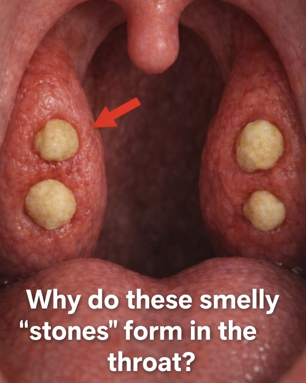Why Do These Small, Smelly White Stones Keep Forming in Your Mouth – And What Can You Do About It?
