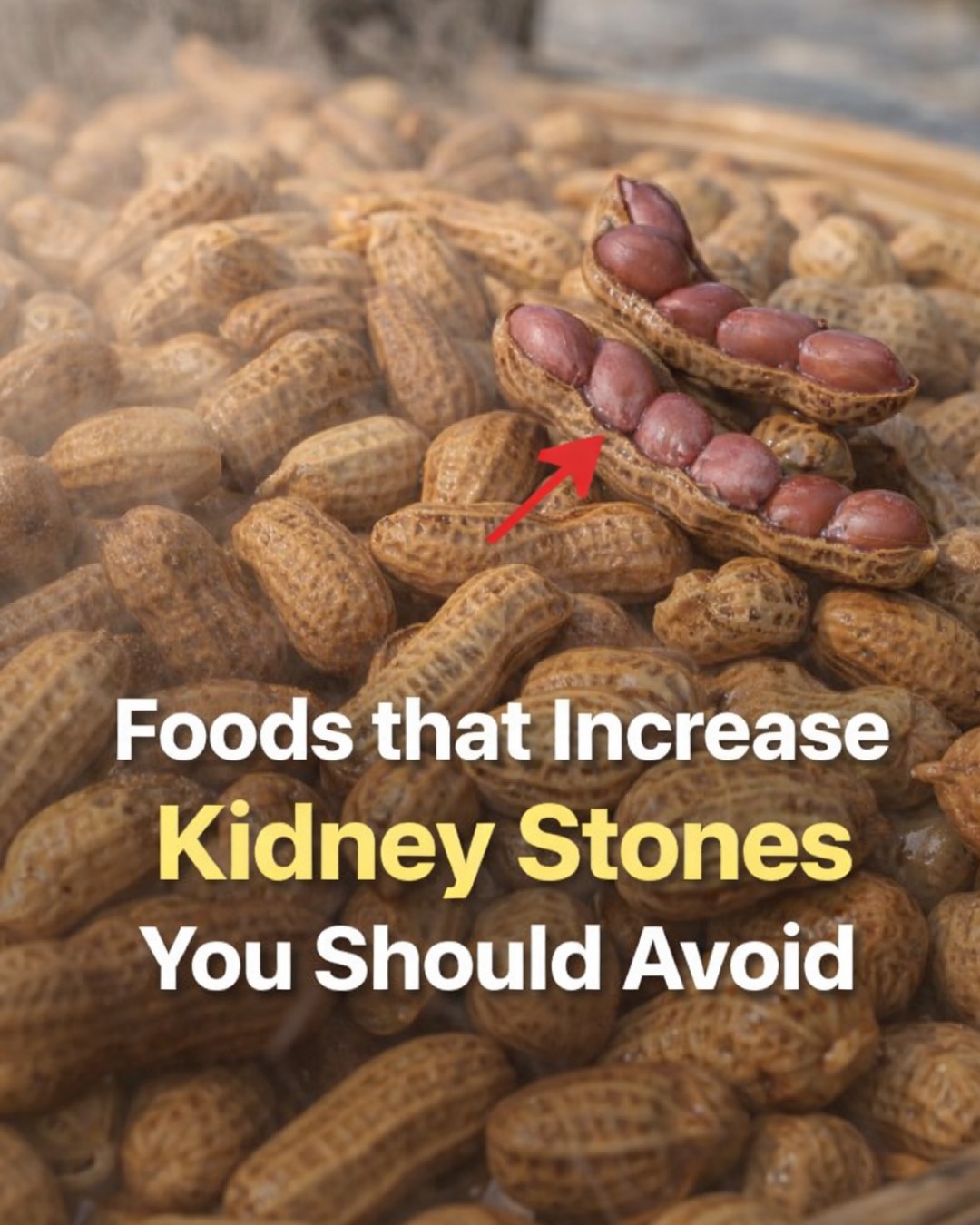 7 Everyday Foods and Drinks That May Contribute to Kidney Stone Risk and Tips to Limit Them