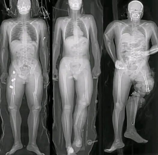The Unspoken Link Between Heart Inflammation and the COVID Vaccine.